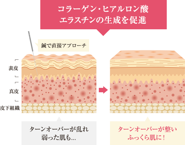 鍼が真皮に直接届き、電気の力で血流を良くすることでターンオーバーを正常化。