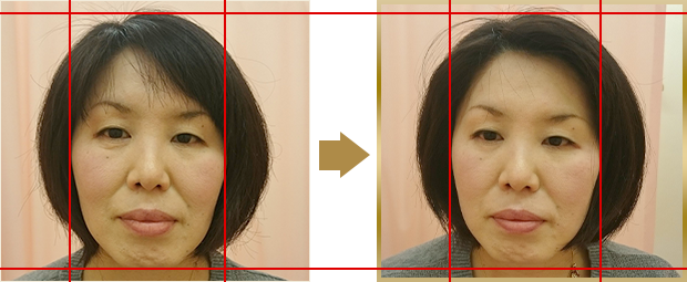 たるみからくるほうれい線を気にされていた